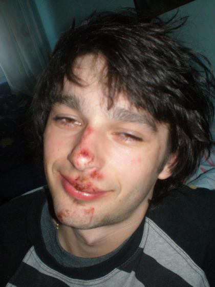 Mateusz Kowalski after Face Lifting